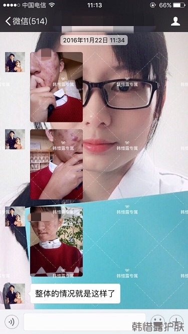 臉上長痘痘怎么去掉？徹底告別痘痘，自卑到自信的蛻變！
