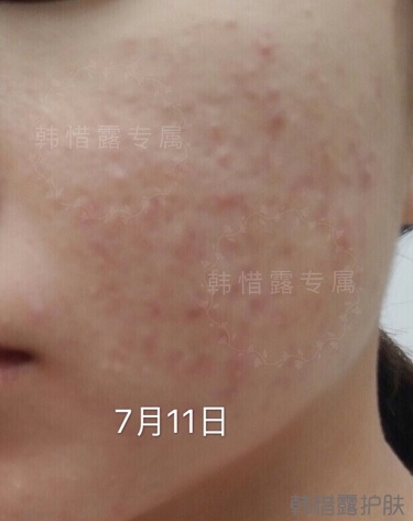 去粉刺效果，單用粉刺膏與祛痘霜也能快快溶解粉刺！
