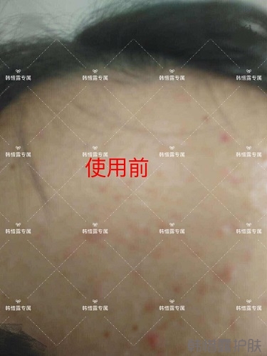額頭長痘臉頰長痘痘粉刺，這樣調理幫你恢復嫩白肌膚！