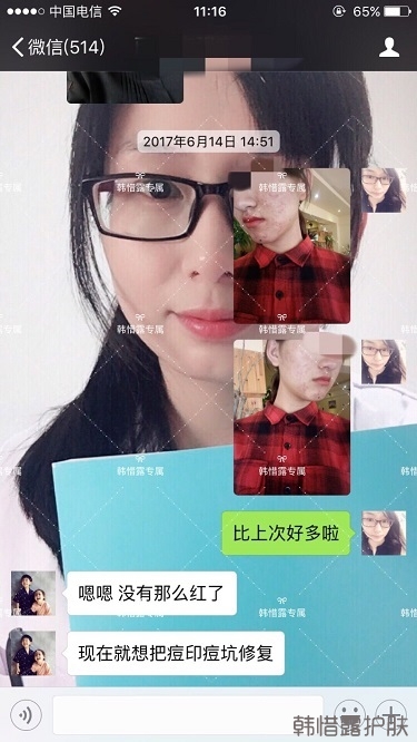 臉上長痘痘怎么去掉？徹底告別痘痘，自卑到自信的蛻變！