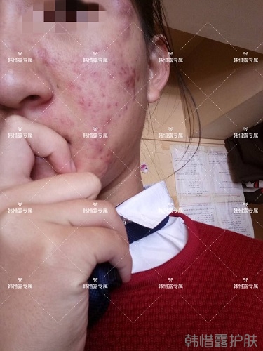 臉上長痘痘怎么去掉？徹底告別痘痘，自卑到自信的蛻變！