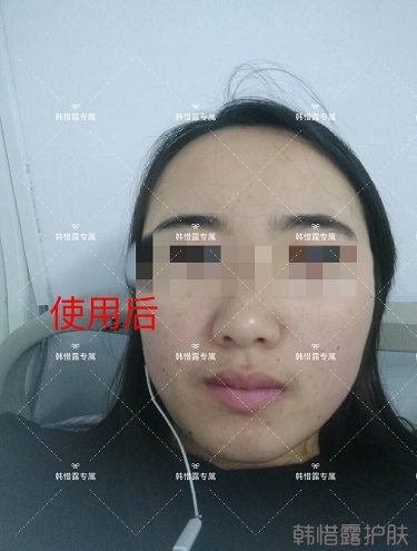 額頭長痘臉頰長痘痘粉刺，這樣調理幫你恢復嫩白肌膚！