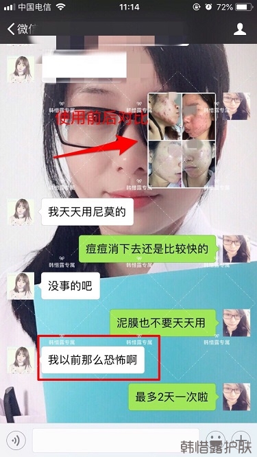 膿包痘祛痘效果，擁有干凈的臉不等待！