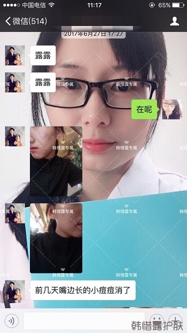 臉上長痘痘怎么去掉？徹底告別痘痘，自卑到自信的蛻變！