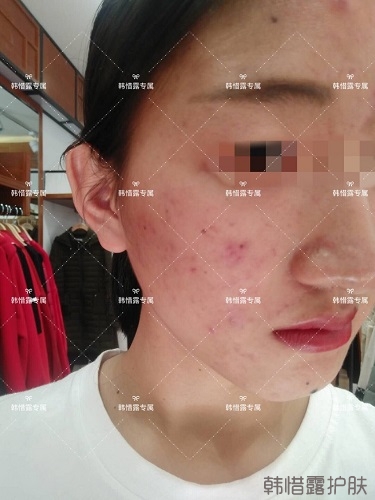 臉上長痘痘怎么去掉？徹底告別痘痘，自卑到自信的蛻變！