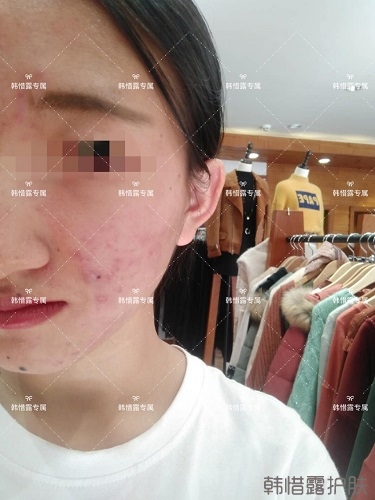臉上長痘痘怎么去掉？徹底告別痘痘，自卑到自信的蛻變！