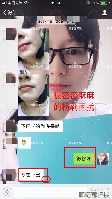 粉刺密密麻麻，試過(guò)很多方法無(wú)果后找韓惜露老師輕松去掉粉刺！