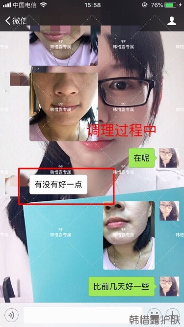 粉刺密密麻麻，試過(guò)很多方法無(wú)果后找韓惜露老師輕松去掉粉刺！