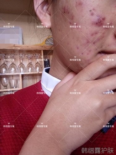 臉上長痘痘怎么去掉？徹底告別痘痘，自卑到自信的蛻變！