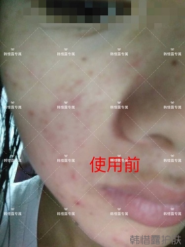 額頭長痘臉頰長痘痘粉刺，這樣調理幫你恢復嫩白肌膚！