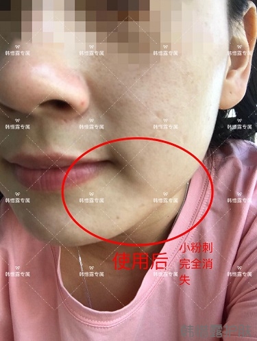 粉刺密密麻麻，試過(guò)很多方法無(wú)果后找韓惜露老師輕松去掉粉刺！
