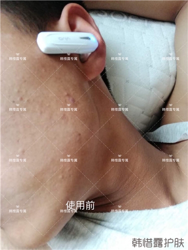 粉刺消了，皮膚光滑了，變帥氣不少呦！