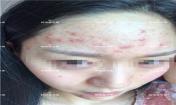 臉上長粉刺怎樣去掉？醫(yī)院都沒搞定韓惜露幫我搞定了，超級開心！【視頻】